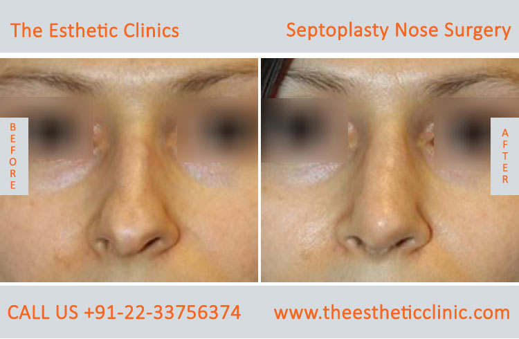 Septoplasty Nose Surgery before after photos in mumbai india (5)